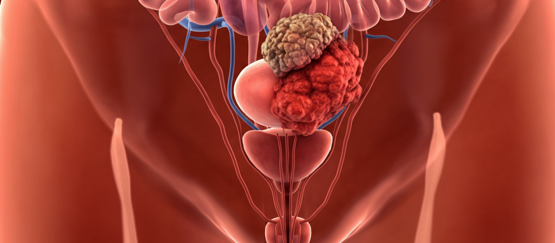 Câncer de Próstata_ Fatores de Risco e Estratégias de Prevenção para Homens Acima de 50 Anos