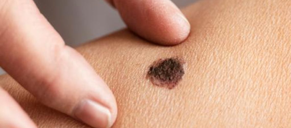 Melanoma_ Como Identificar Sinais Suspeitos na Pele