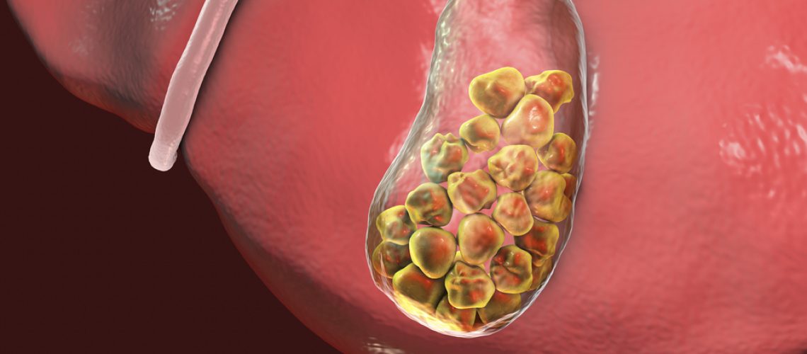 cálculo de vesícula biliar